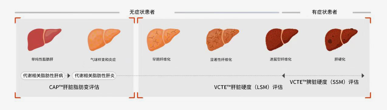 FibroScan? examination can provide a basis fortreatment decisions in various liver diseases
